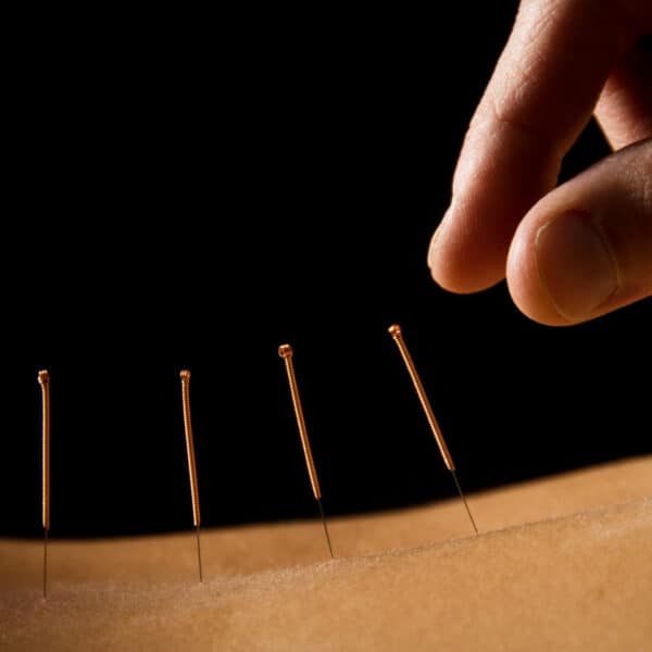 acupuncture