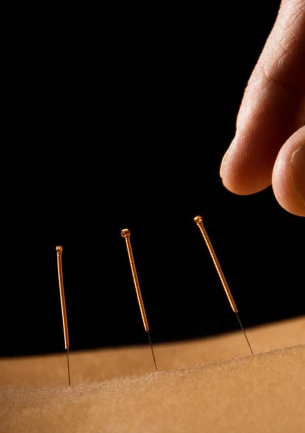 An Introduction to Acupuncture