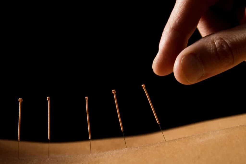 acupuncture needles